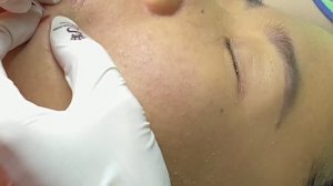 Удаление подкожных прыщей и комедонов на лице