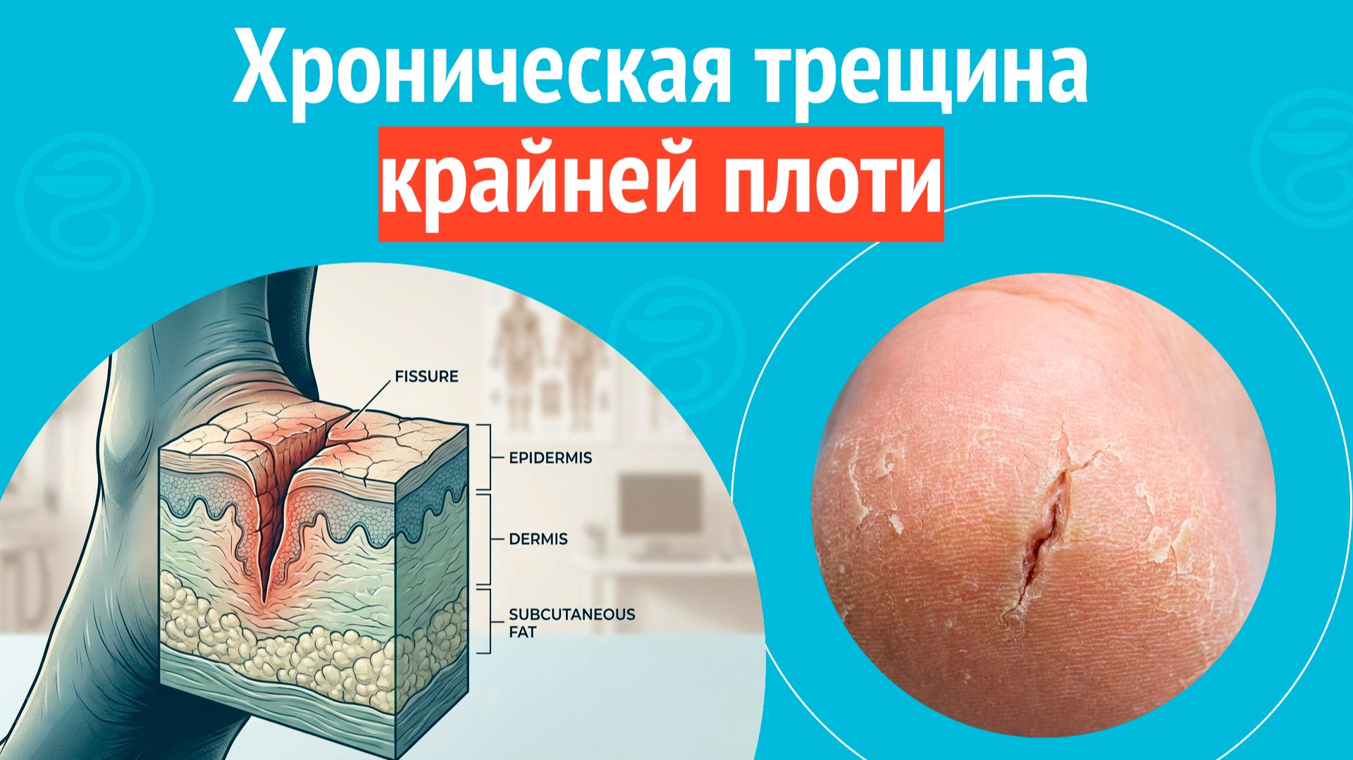 😠 Хроническая трещина крайней плоти. Клинический случай № 1711 смотреть онлайн