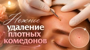 Мягкое освобождение пор от жира через экстракцию сальных нитей и белых угрей