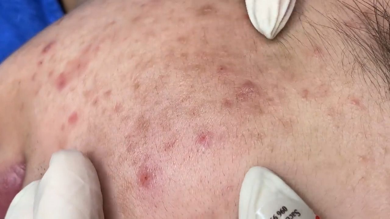229 • Acne collection • АСМР • Relax Spa смотреть онлайн
