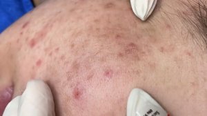229 • Acne collection • АСМР • Relax Spa