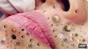 ЧИСТКА ЛИЦА КРУПНЫМ ПЛАНОМ