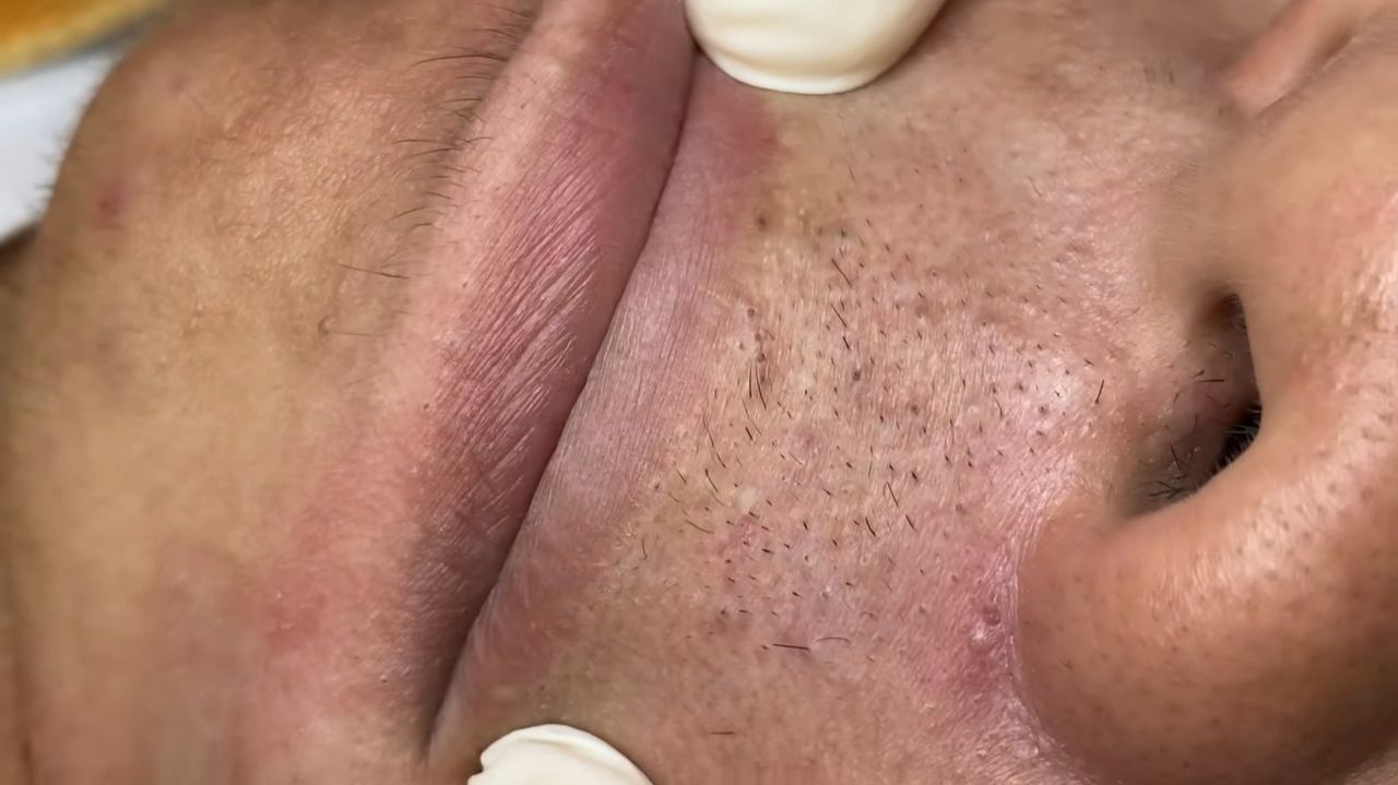 244 • Acne collection • АСМР • Relax Spa смотреть онлайн