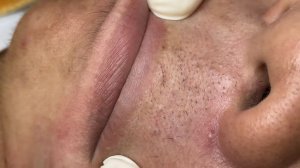 244 • Acne collection • АСМР • Relax Spa