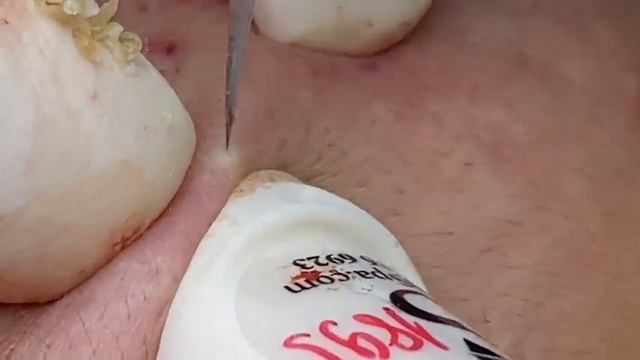 ВЫДАВЛИВАЕТ ПРЫЩИ И УГРИ. СОЧНОЕ РЕЛАКС ВИДЕО смотреть онлайн