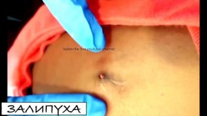 Выдавливание прыщей и удаление черных точек