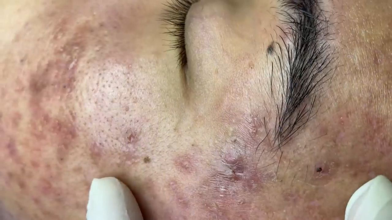 241 • Acne collection • АСМР • Relax Spa смотреть онлайн