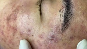 241 • Acne collection • АСМР • Relax Spa