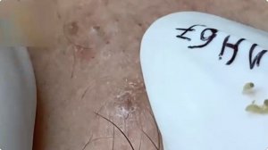 #291 Удаление акне. Экстракция комедонов. Подкожные прыщи. Чистка от черных точек