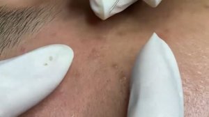 Удаление комедонов и прыщей на лице