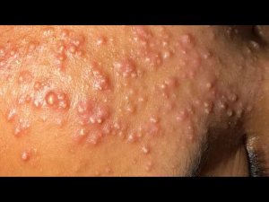 Глубокое удаление черных точек | Корейский уход за кожей для чистого и сияющего лица