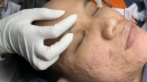 ASMR удаление прыщей и черных точек с лица