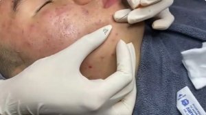 Безопасное удаление прыщей и комедонов
