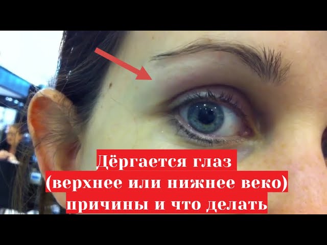 Почему дергается глаз 👁️ (верхнее или нижнее веко) причины и лечение смотреть онлайн