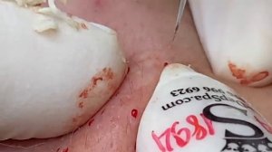 ВЫДАВЛИВАЕТ ПРЫЩИ И УГРИ. СОЧНОЕ РЕЛАКС ВИДЕО