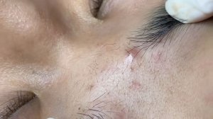 243 • Acne collection • АСМР • Relax Spa