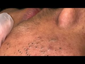 Глубокое очищение пор и удаление черных точек | Сборник | Skin Solutions