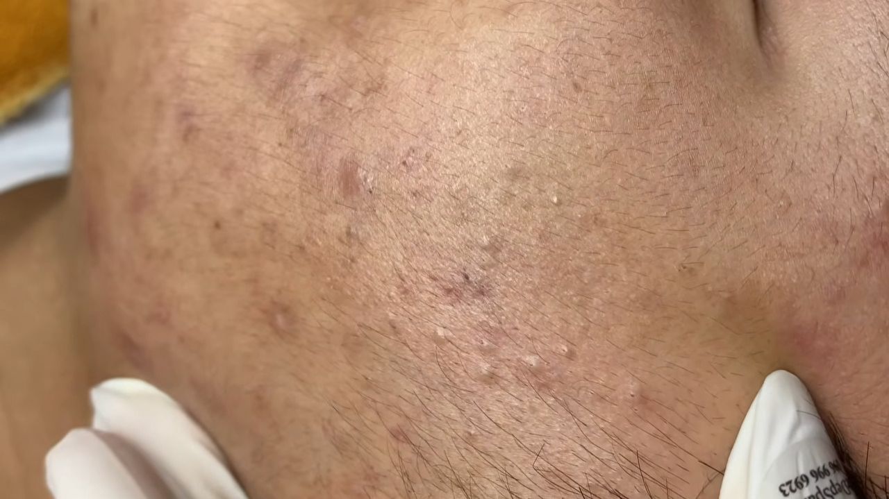 242 • Acne collection • АСМР • Relax Spa смотреть онлайн