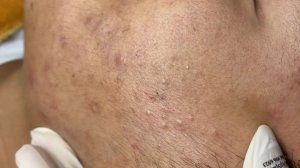 242 • Acne collection • АСМР • Relax Spa