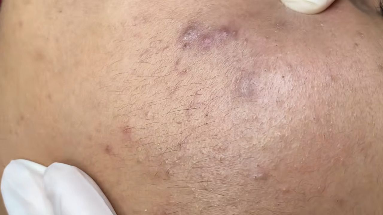 245 • Acne collection • АСМР • Relax Spa смотреть онлайн