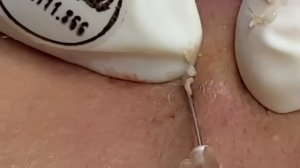Выдавливание прыщей, угрей, черных точек и камедонов #570