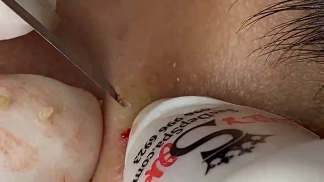 ВЫДАВЛИВАЕТ ПРЫЩИ И УГРИ. СОЧНОЕ РЕЛАКС ВИДЕО смотреть онлайн
