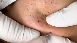 Корейская чистка лица Глубокое удаление загрязнений 44563