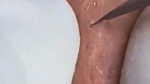 ШОК! ОГРОМНЫЕ ПРЫЩИ УДАЛЕНИЕ ПРОФЕССИОНАЛЬНО