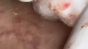 Корейская чистка лица Глубокое удаление загрязнений 12341