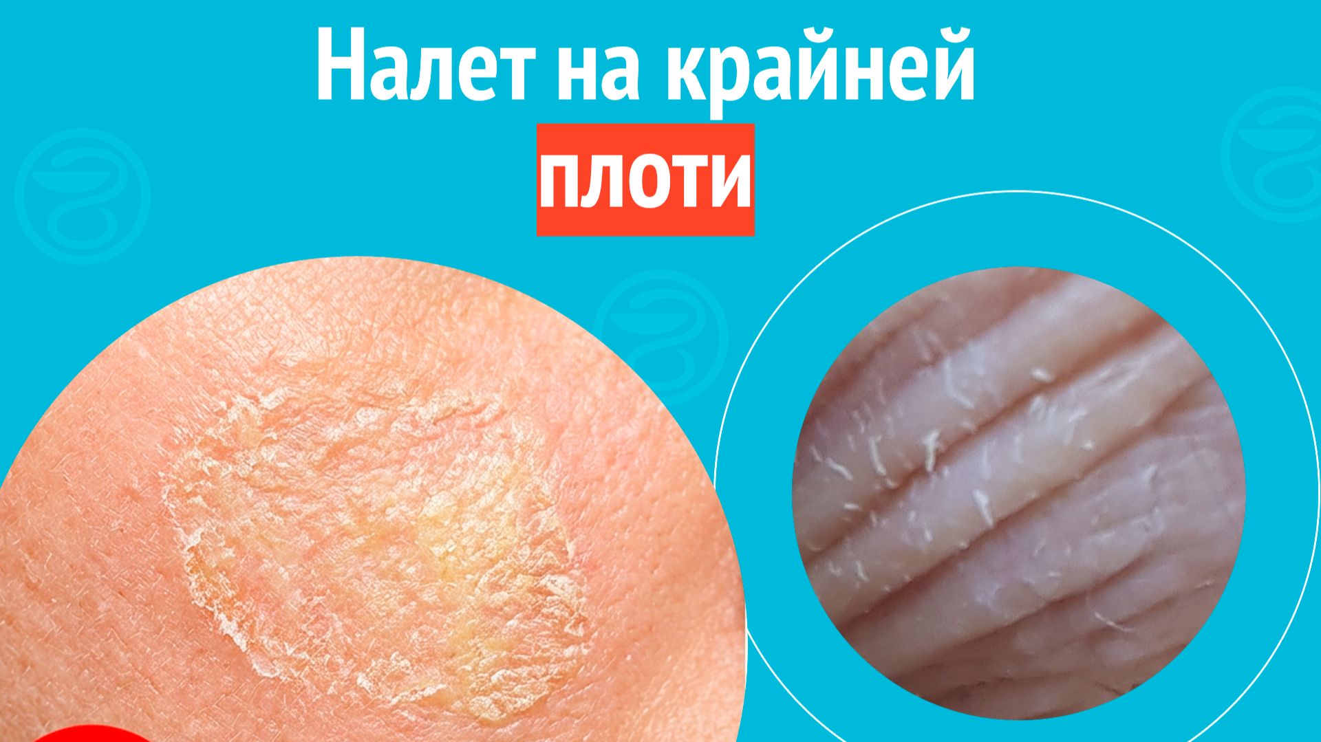 😦 Налет на крайней плоти. Клинический случай №1707 смотреть онлайн