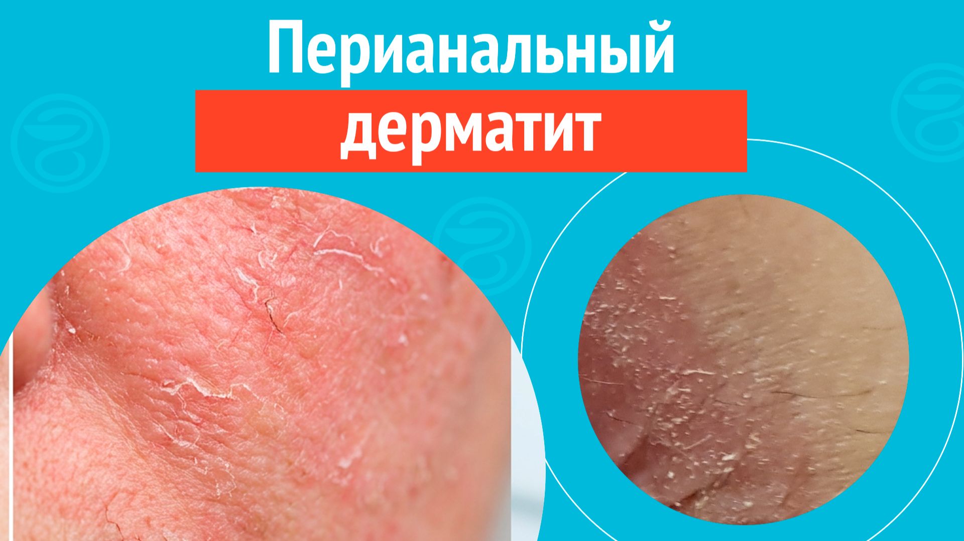 😦 Перианальный дерматит. Клинический случай №1701 смотреть онлайн