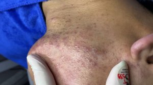 248 • Acne collection • АСМР • Relax Spa