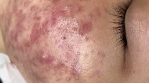 252 • Acne collection • АСМР • Relax Spa