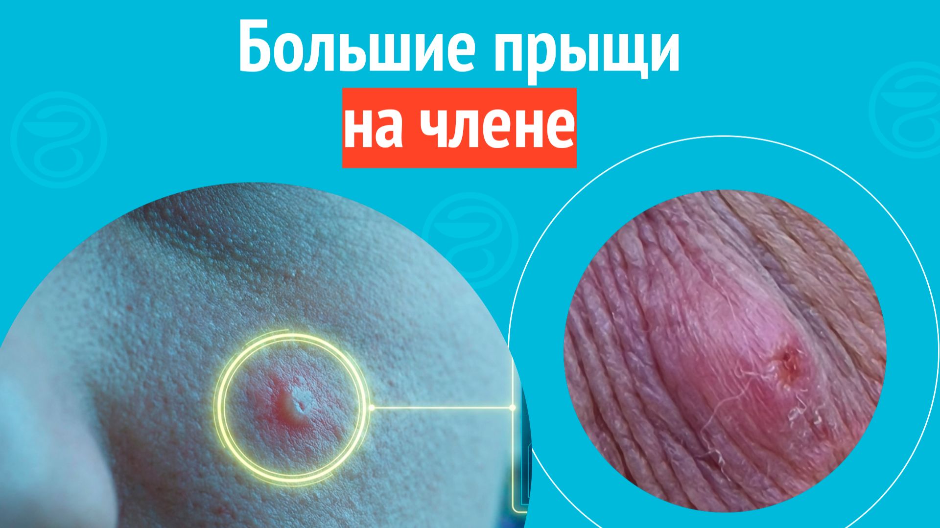😧 Большие прыщи на члене. Клинический случай №1703 смотреть онлайн