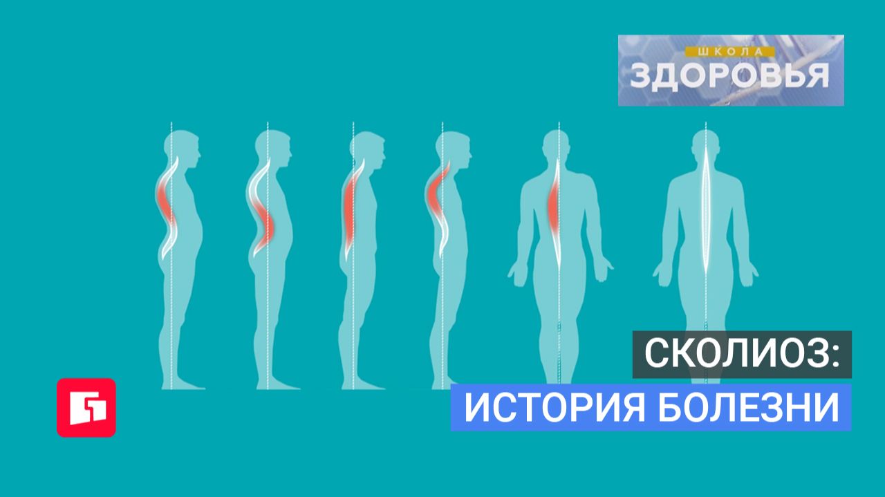 Сколиоз: История болезни. Школа здоровья. GuberniaTV