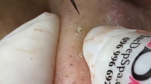 РЕЛАКС ВИДЕО.  ВЫДАВЛИВАНИЕ ПРЫЩЕЙ