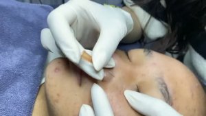 Чистка лица от гормональных прыщей и комедонов