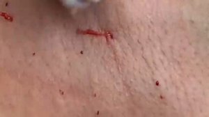 ВЫДАВЛИВАЕТ ПРЫЩИ И УГРИ. СОЧНОЕ РЕЛАКС ВИДЕО давить угри и прыщи