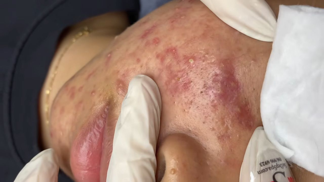 251 • Acne collection • АСМР • Relax Spa смотреть онлайн