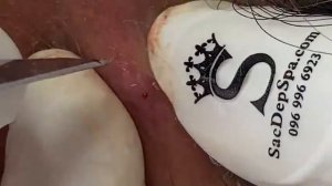 ВЫДАВЛИВАЕТ ПРЫЩИ И УГРИ. СОЧНОЕ РЕЛАКС ВИДЕО давить угри и прыщи