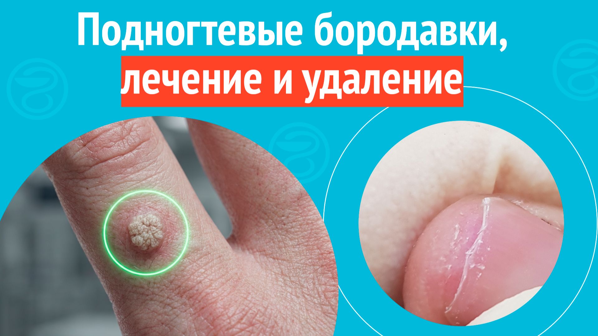 ✋ Подногтевые бородавки, лечение и удаление. Клинический случай №1702 смотреть онлайн