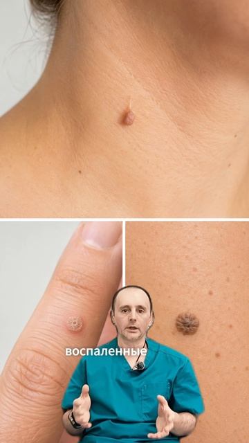 Что пациенты часто называют папилломами