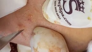 ВЫДАВЛИВАЕТ ПРЫЩИ И УГРИ. СОЧНОЕ РЕЛАКС ВИДЕО давить угри и прыщи