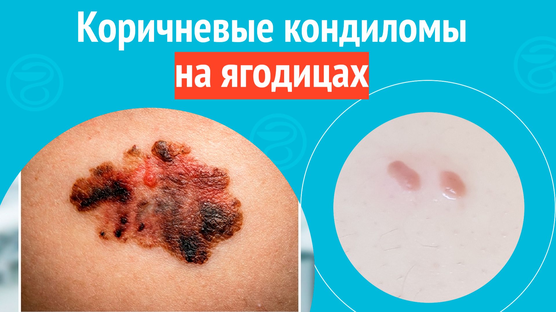 🦵 Коричневые кондиломы на ягодицах. Клинический случай №1708 смотреть онлайн