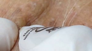 ВЫДАВЛИВАЕТ ПРЫЩИ И УГРИ. СОЧНОЕ РЕЛАКС ВИДЕО давить угри и прыщи