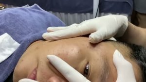 Удаление комедонов с лица на щеках и скулах