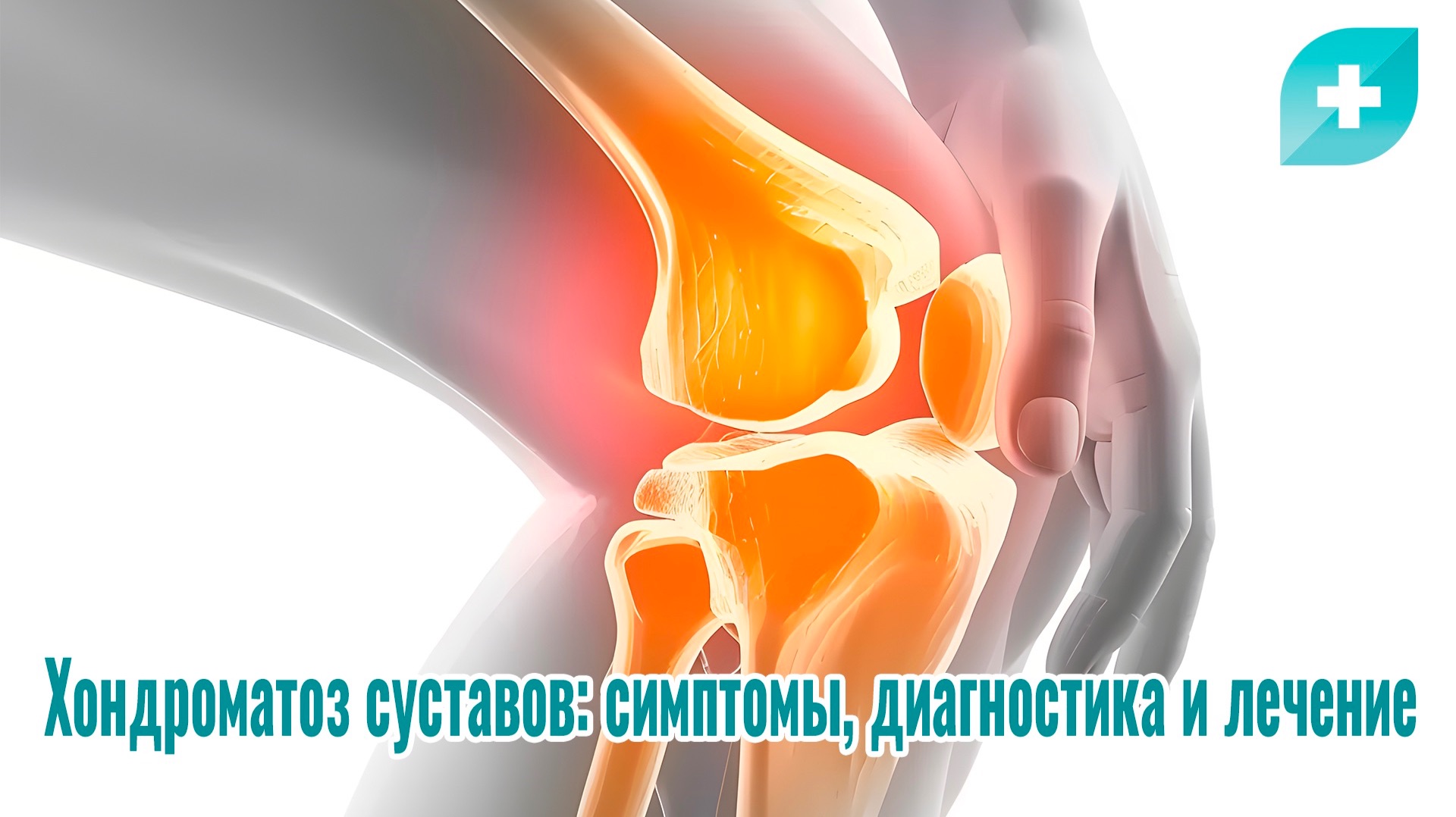 Хондроматоз суставов: симптомы, диагностика и лечение