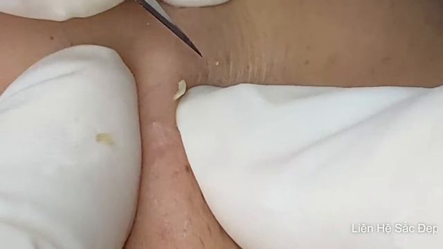 ПРЫЩИ И УГРИ. СОЧНОЕ РЕЛАКС ВИДЕО давить угри и прыщи смотреть онлайн