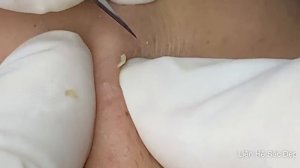 ПРЫЩИ И УГРИ. СОЧНОЕ РЕЛАКС ВИДЕО давить угри и прыщи