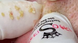 ВЫДАВЛИВАЕТ ПРЫЩИ И УГРИ. СОЧНОЕ РЕЛАКС ВИДЕО давить угри и прыщи
